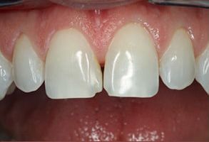 All Smiles Dental Care | Veneers, Dentures and Dental Fillings